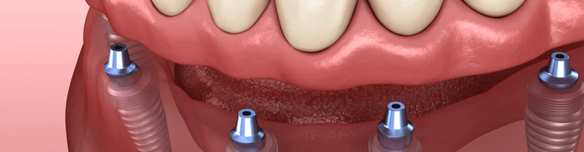 3D render showing dental implants with screws in jawbone and floating teeth above.