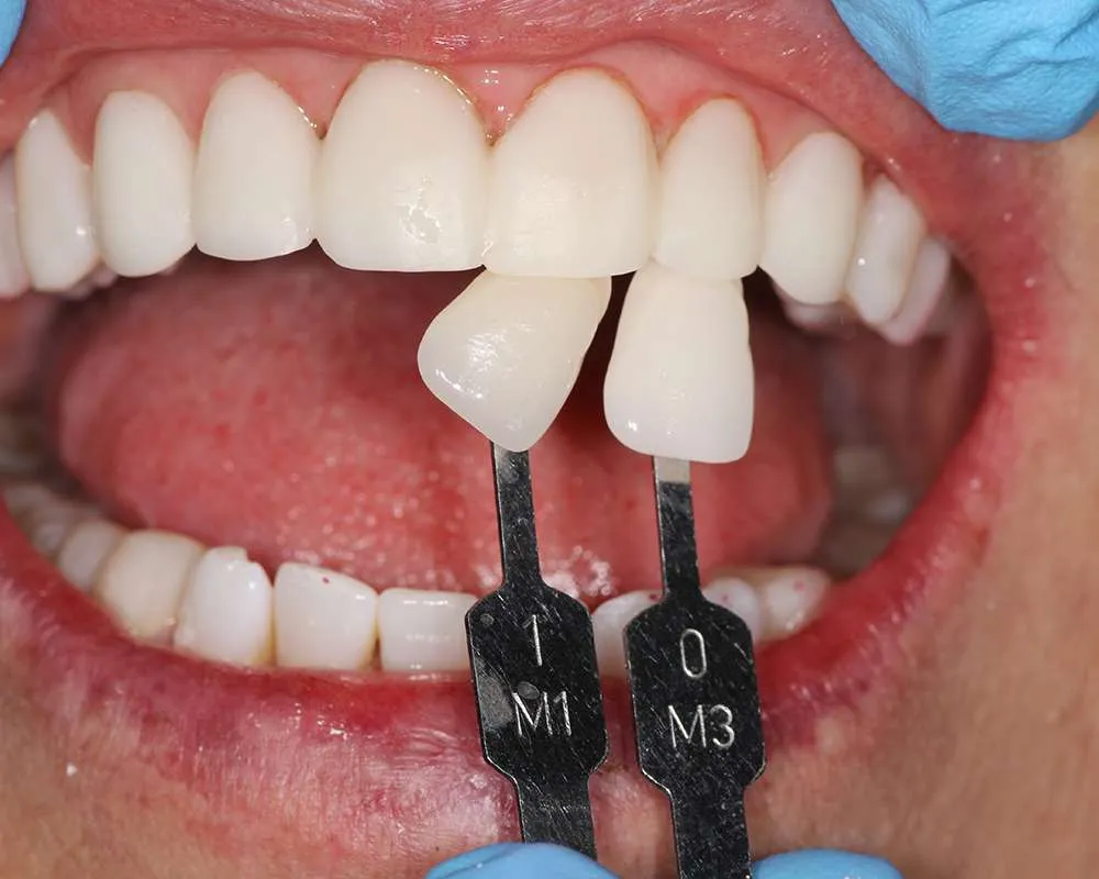 Photo of Temps – Checking Color denture
