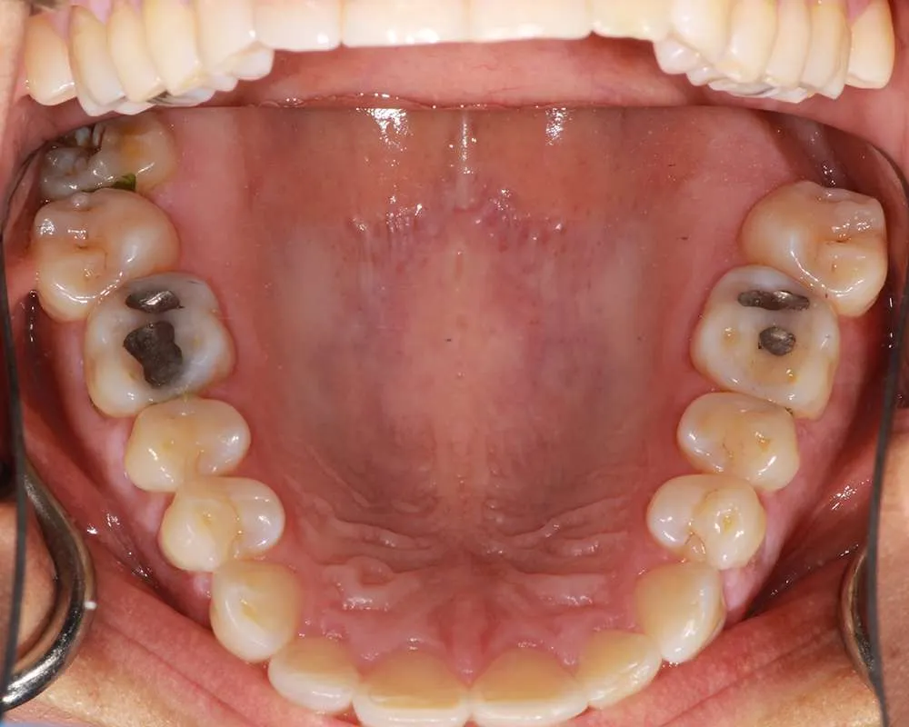 Photo of before upper veneers