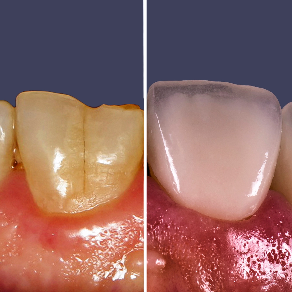 A comparative image showing a tooth model before and after an ultra-thin veneer application. The 'before' side displays the original tooth's natural, slightly worn appearance, and the 'after' side showcases the tooth covered with a veneer, demonstrating its perfect fit and enhanced, glossy white finish.