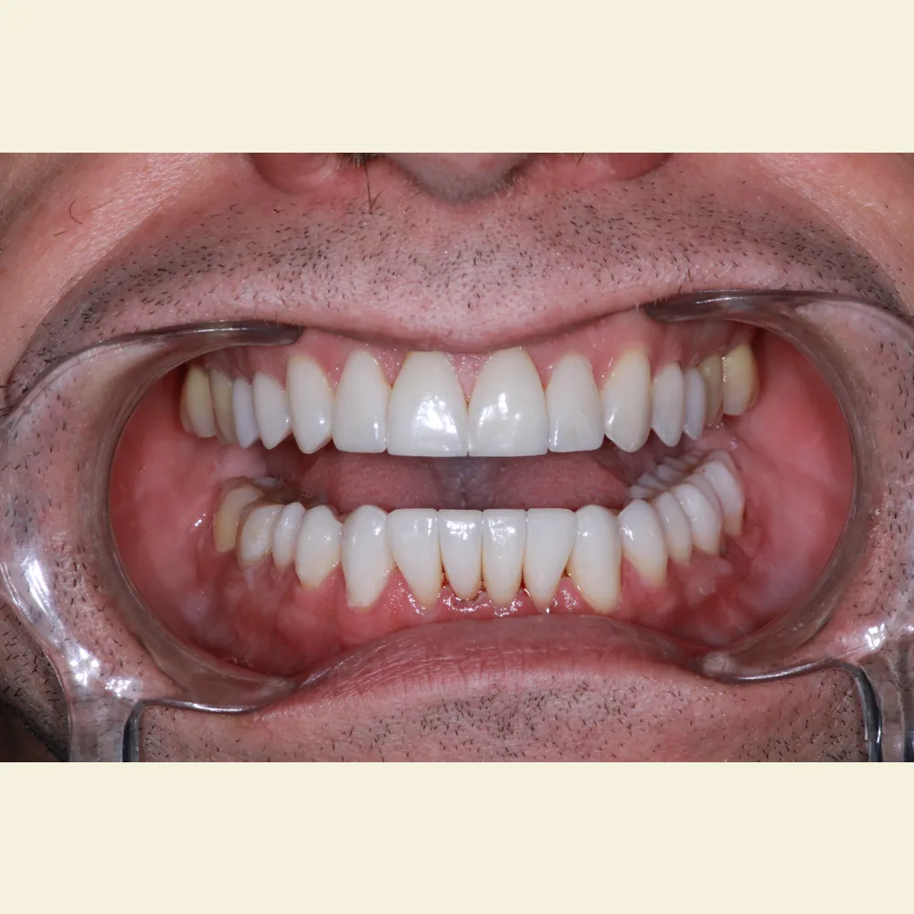 Photo of a patient before and after