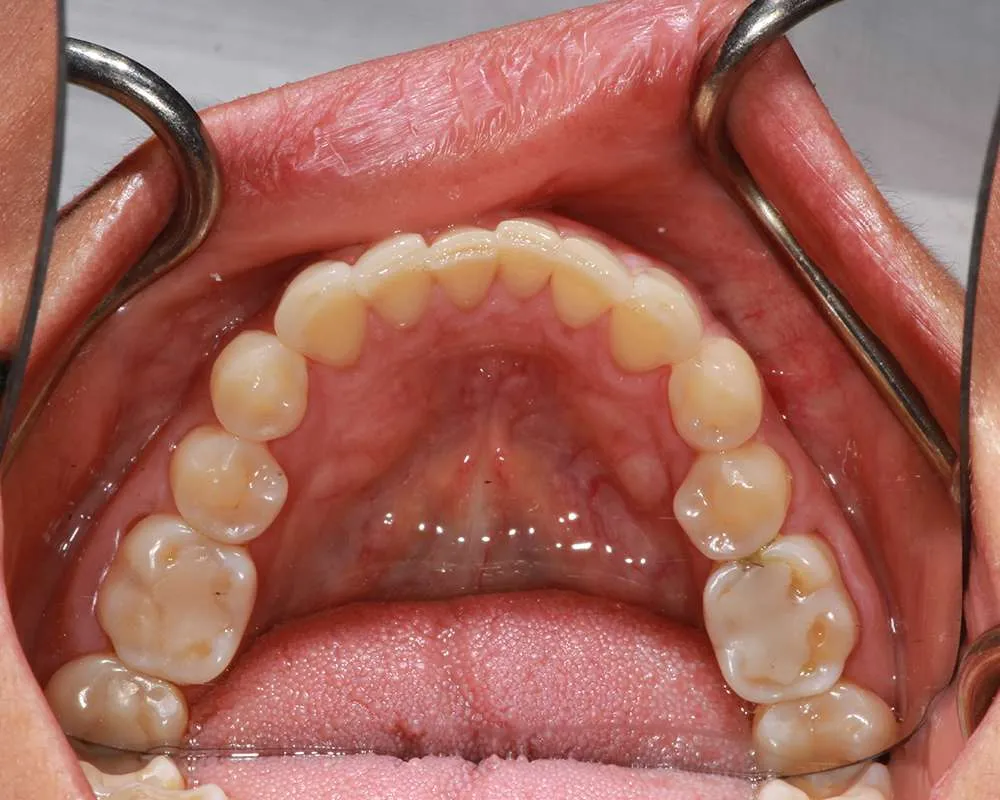 Photo of vefore lower veneers