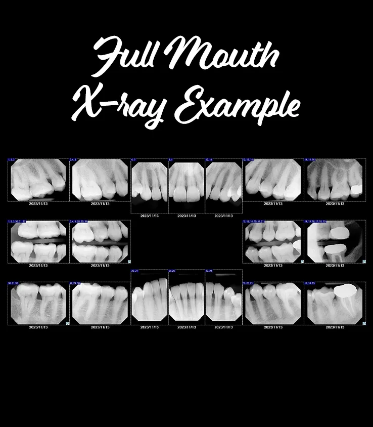 An image showing a full mouth x-rays example.