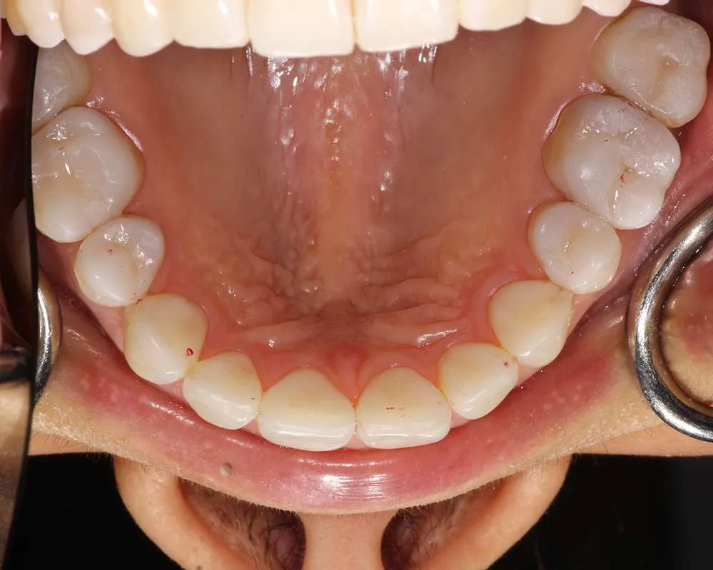 Photo of after upper denture