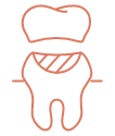 Graphic icon of onlay crown