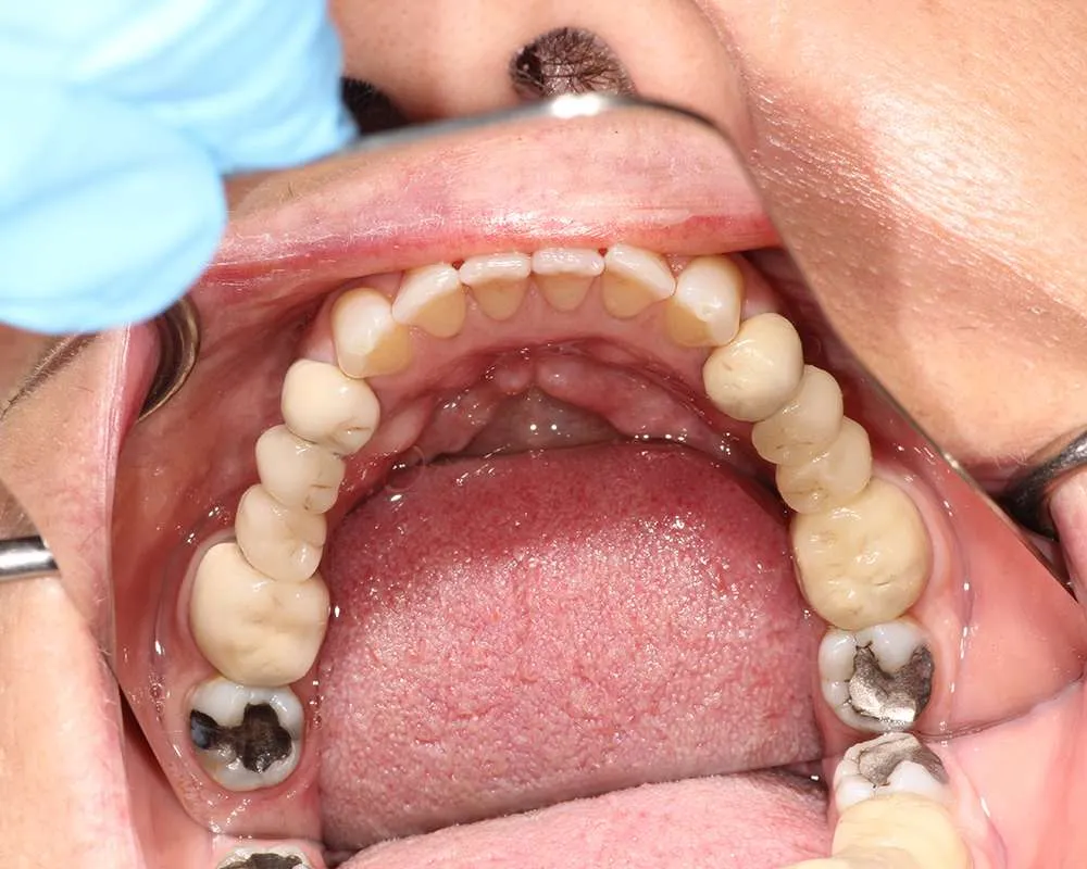 Photo of Before Lowers denture