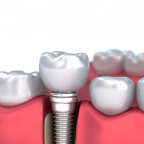 3D render of dental implant beside natural teeth on white background.