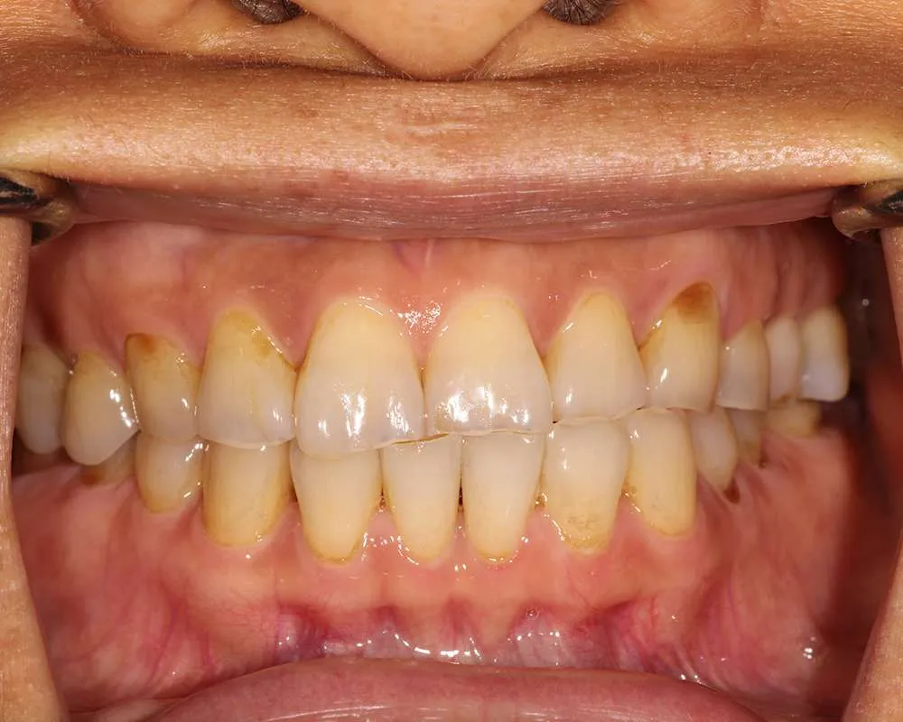 Before retracted denture photo