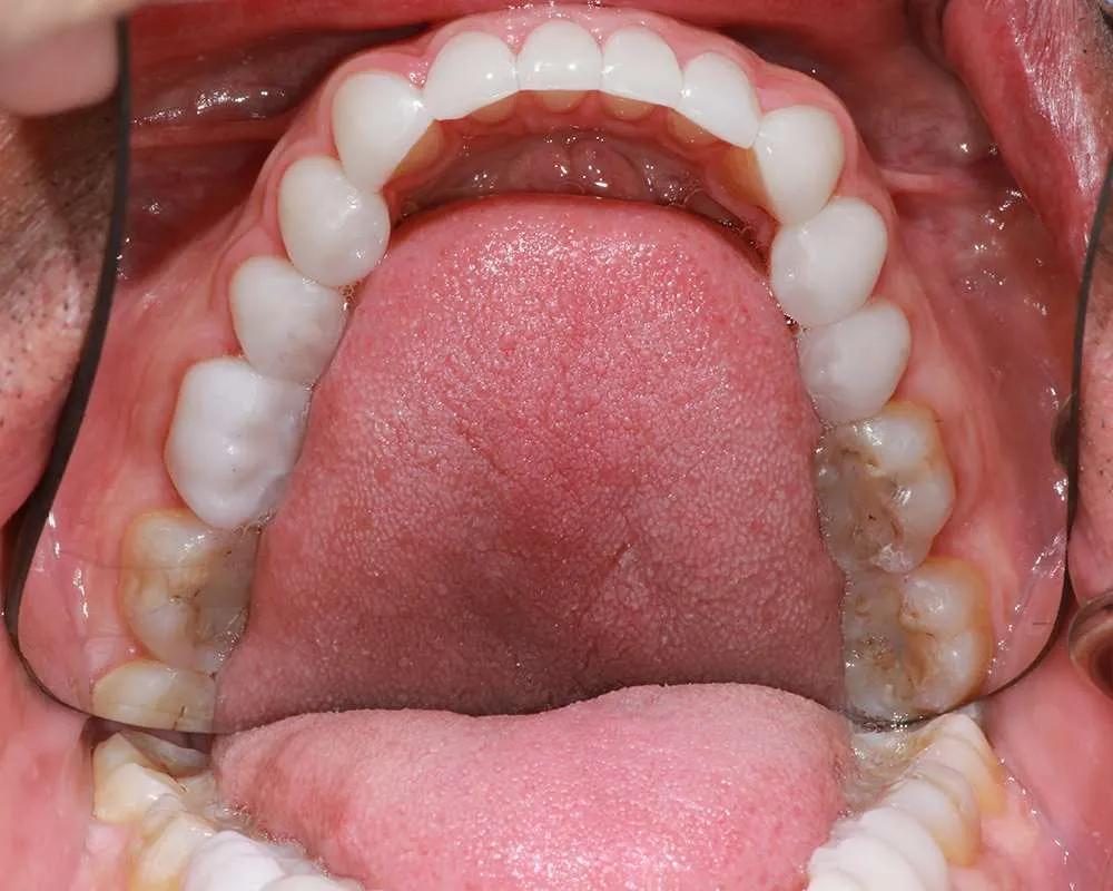 Photo of after lower denture