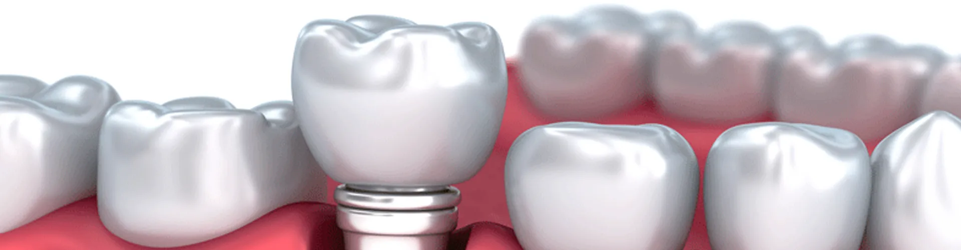 3D render of dental implant beside natural teeth on white background.