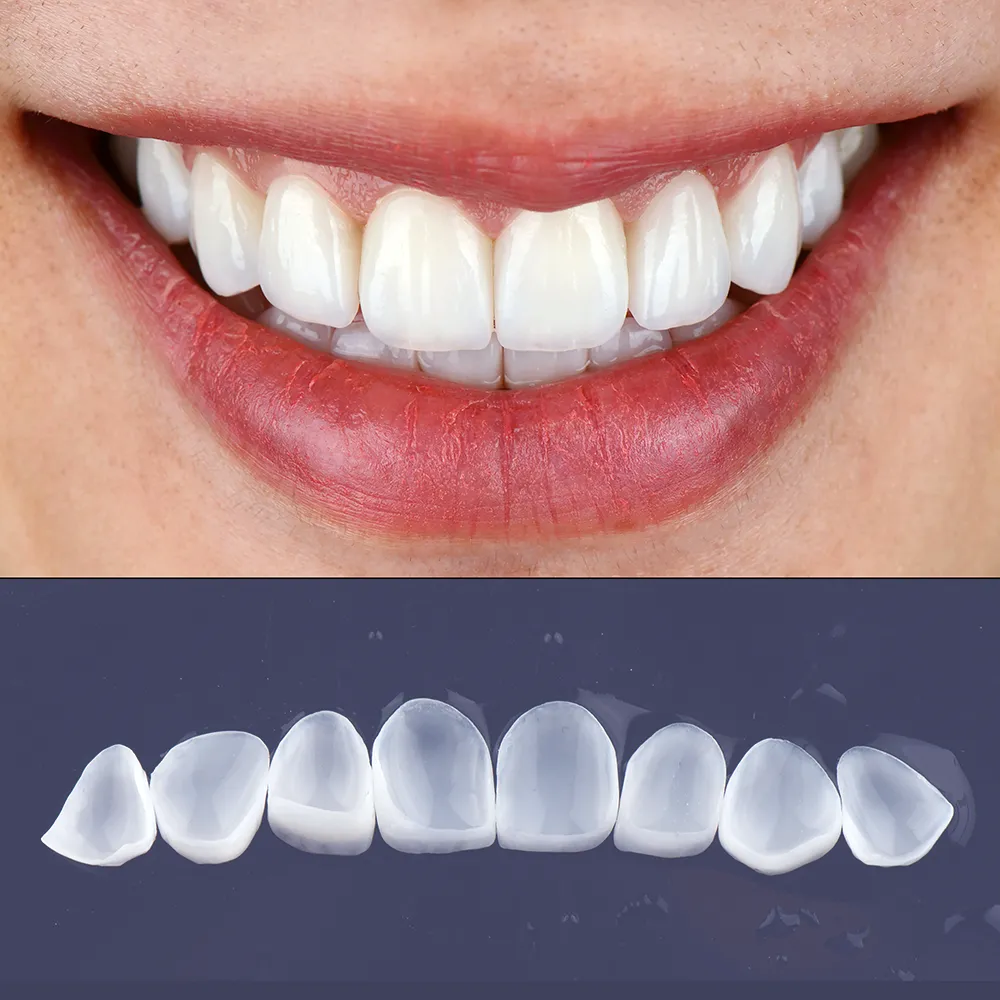 The top image features a close-up view of a person's smile with ultra-thin veneers, showing well-aligned, bright white teeth. Below is a separate image displaying a set of eight ultra-thin veneer shells on a dark background, illustrating their translucent quality and natural tooth-like shape.