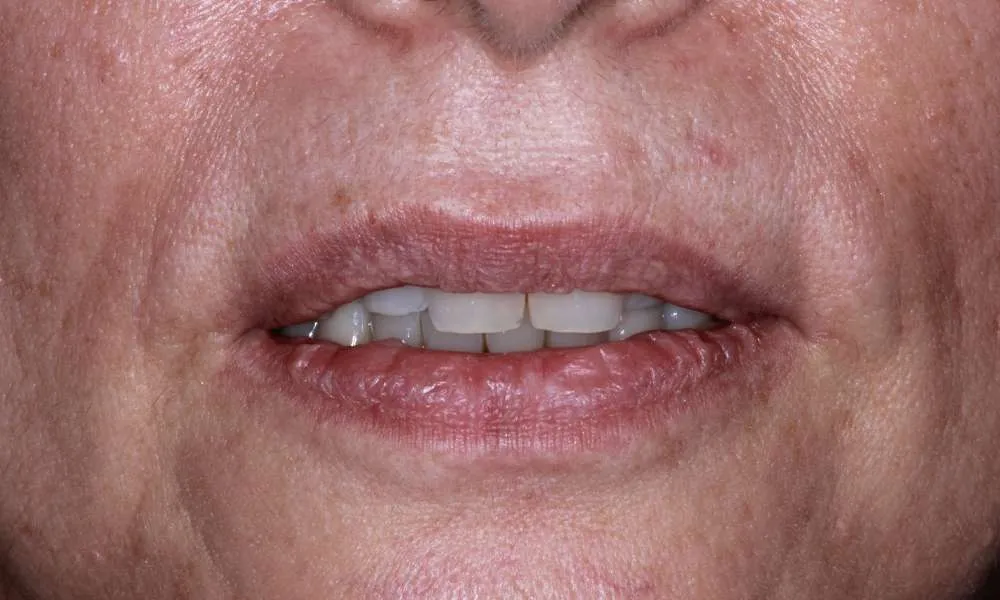 Photo of before patient denture