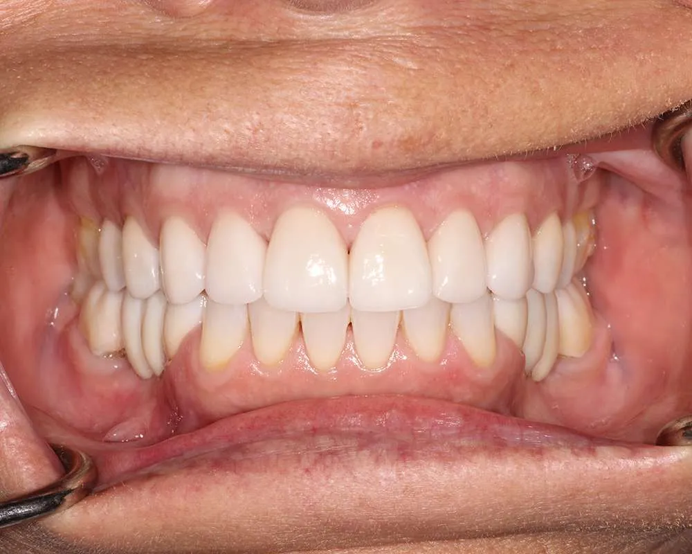Photo of Finals Retracted denture