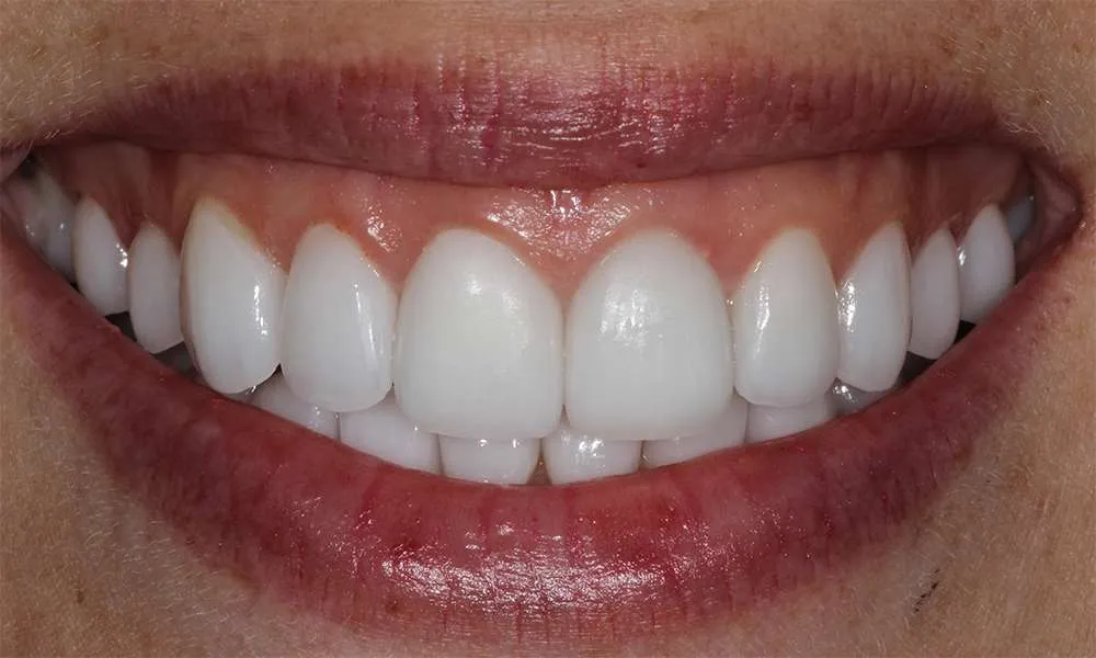 Photo of after retracted