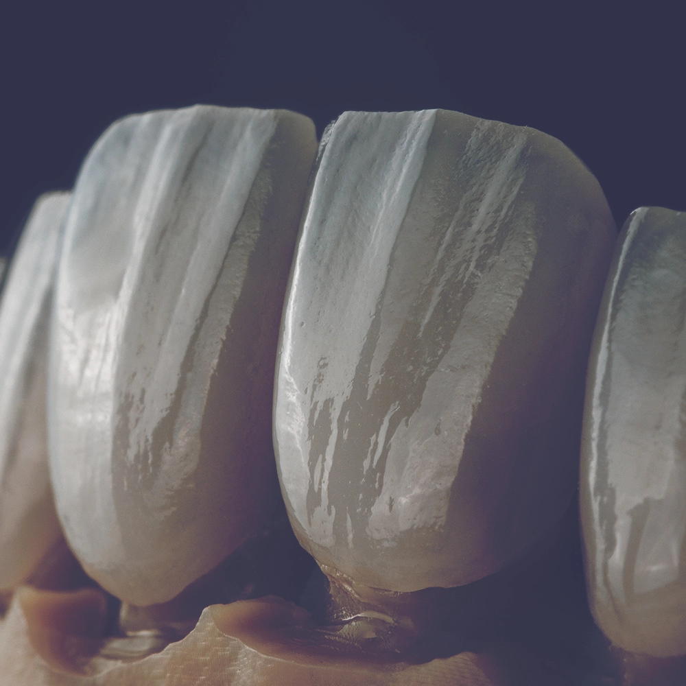 Close-up image of a set of ultra-thin veneers, showcasing the detailed texture and natural-looking translucent quality of the ceramic material against a dark background.