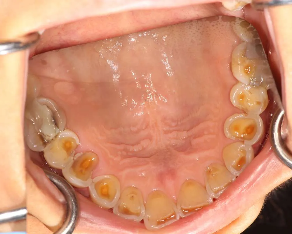 Before lowers denture photo