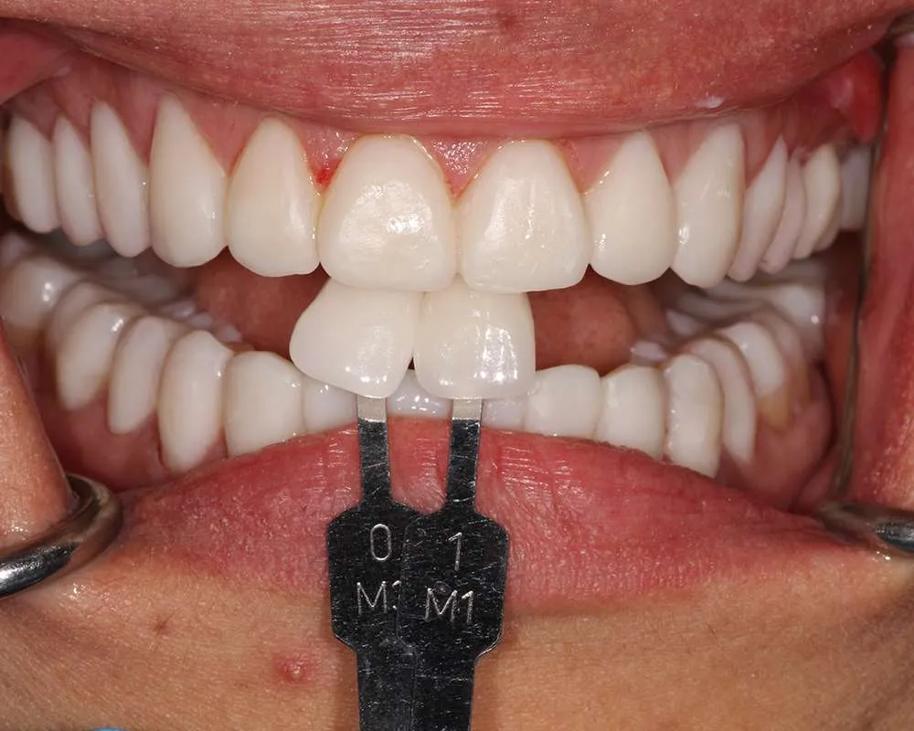 Photo of temps veneers
