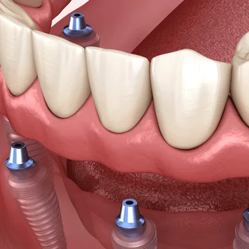 3D render showing dental implants with screws in jawbone and floating teeth above.