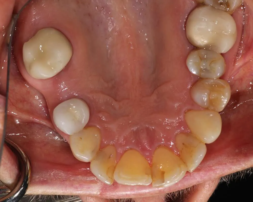 Photo of Before Lowers denture