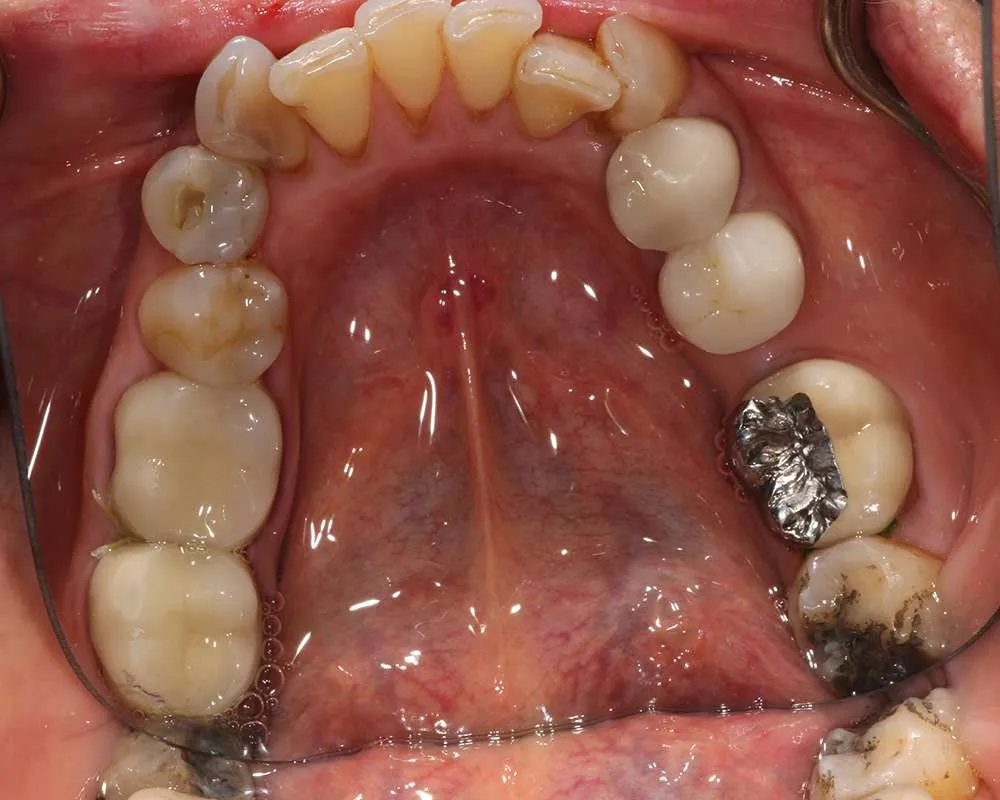 Photo of Before Uppers denture