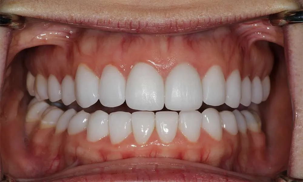 Photo of Temps denture