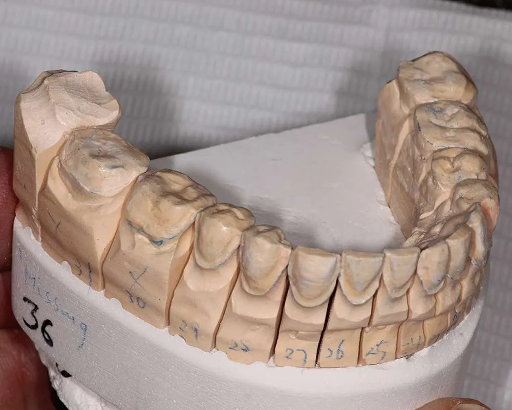 Photo of preplanning denture