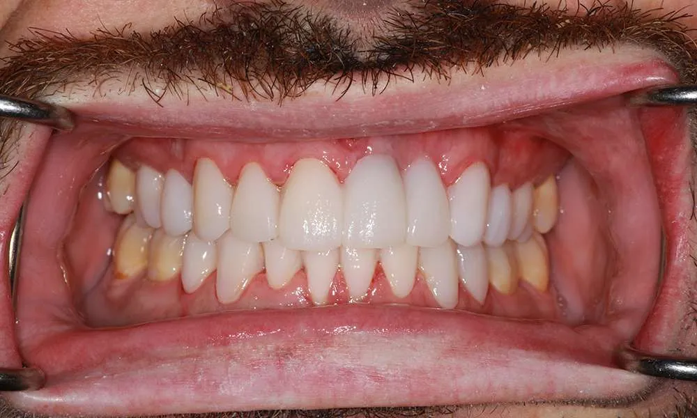 Photo of Temps denture