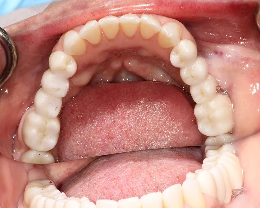 Photo of Final Lowers denture