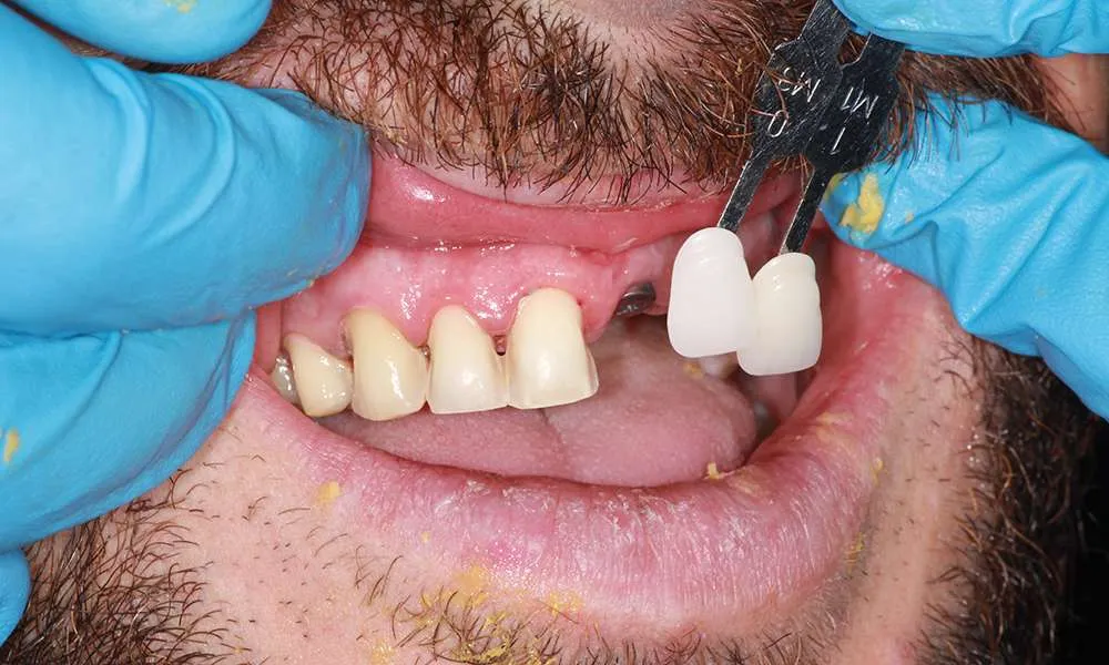 Photo of checking color denture
