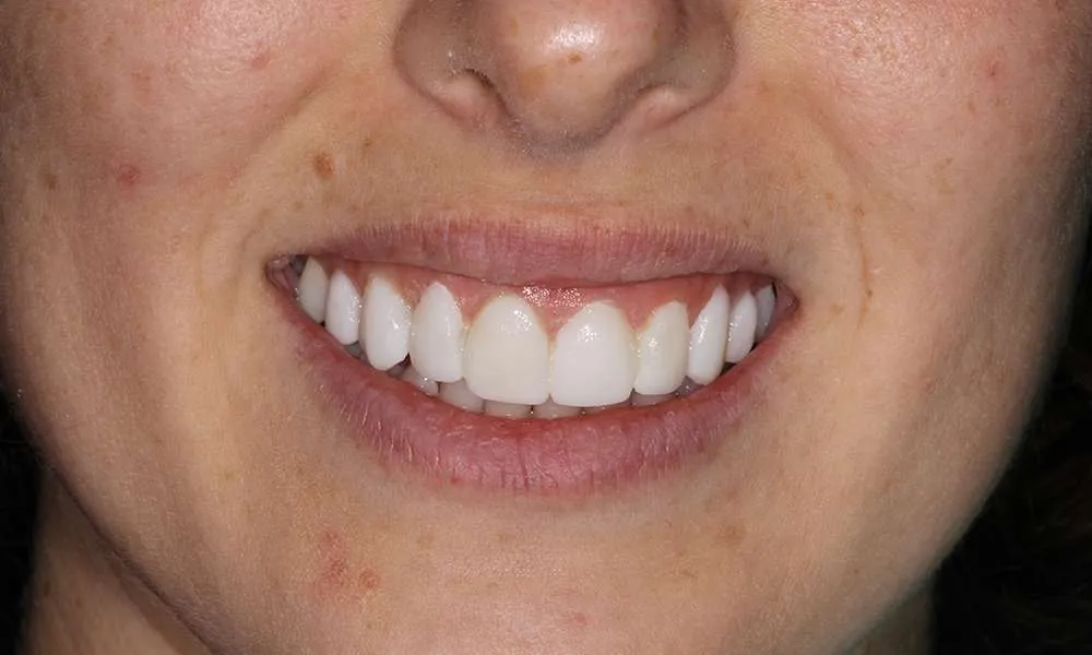 Photo of Temps denture
