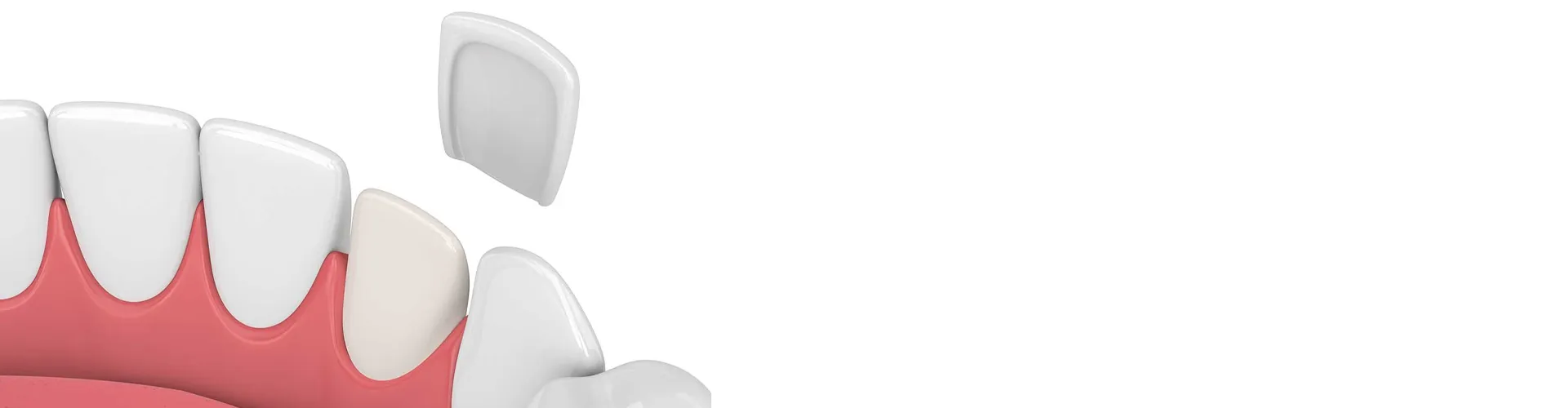 3D render of set of teeth getting a veneer in one of them.