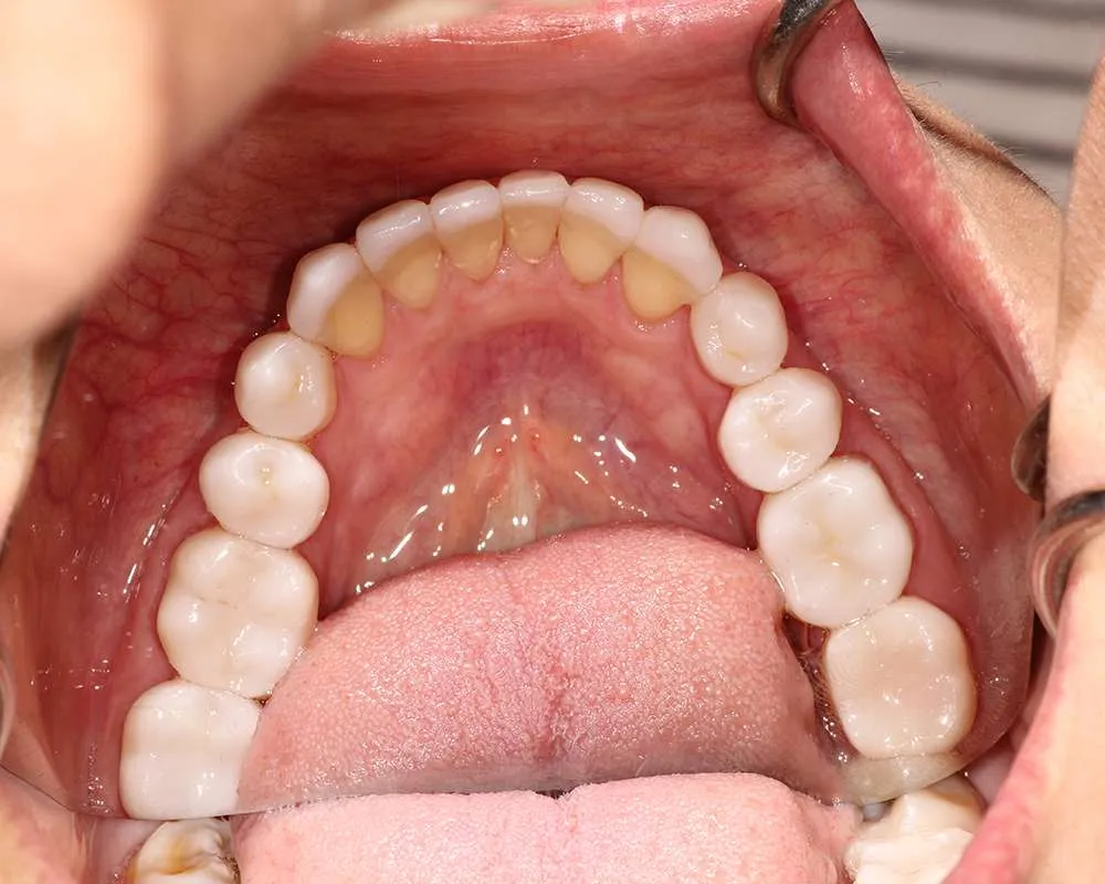 Photo of after lower veneers