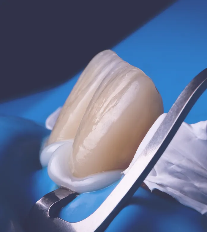 Close-up of a dental procedure involving the use of a rubber dam and dental instruments to place veneers on teeth, highlighting precision in dental care.