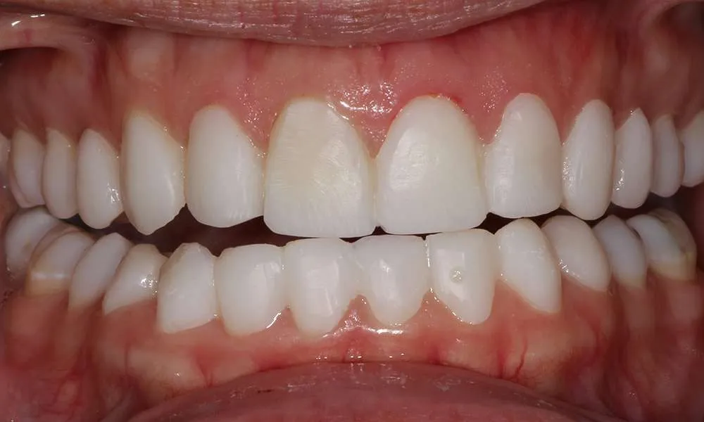 Photo of Before Laughing 