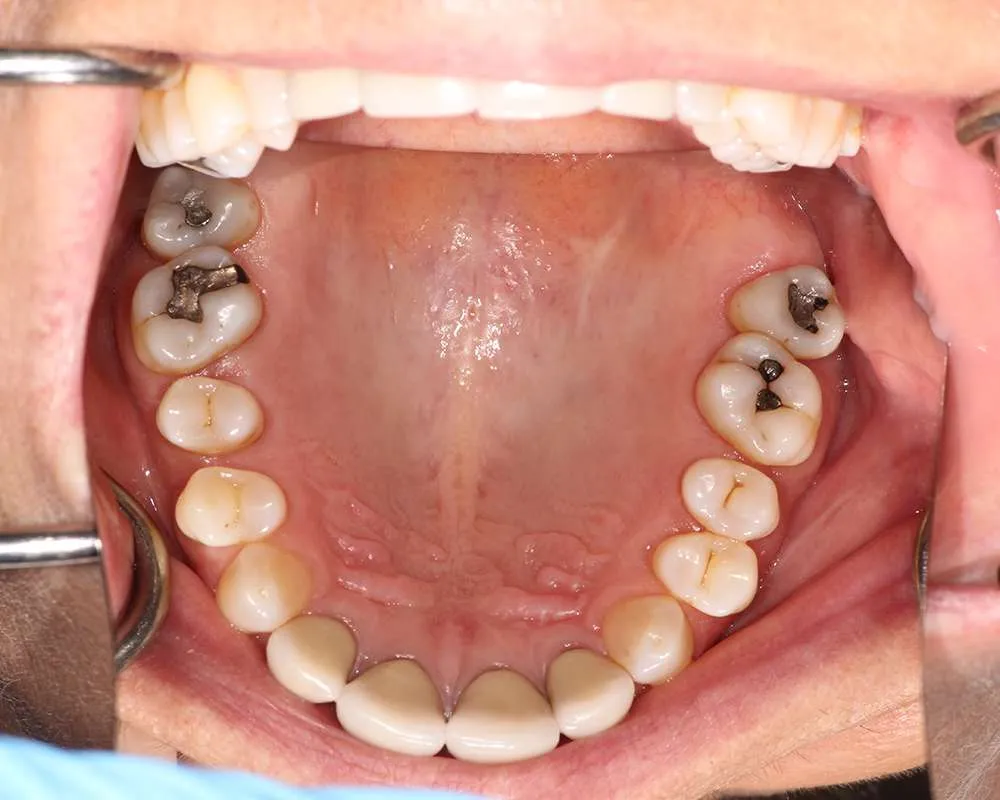 Photo of Before Retracted denture