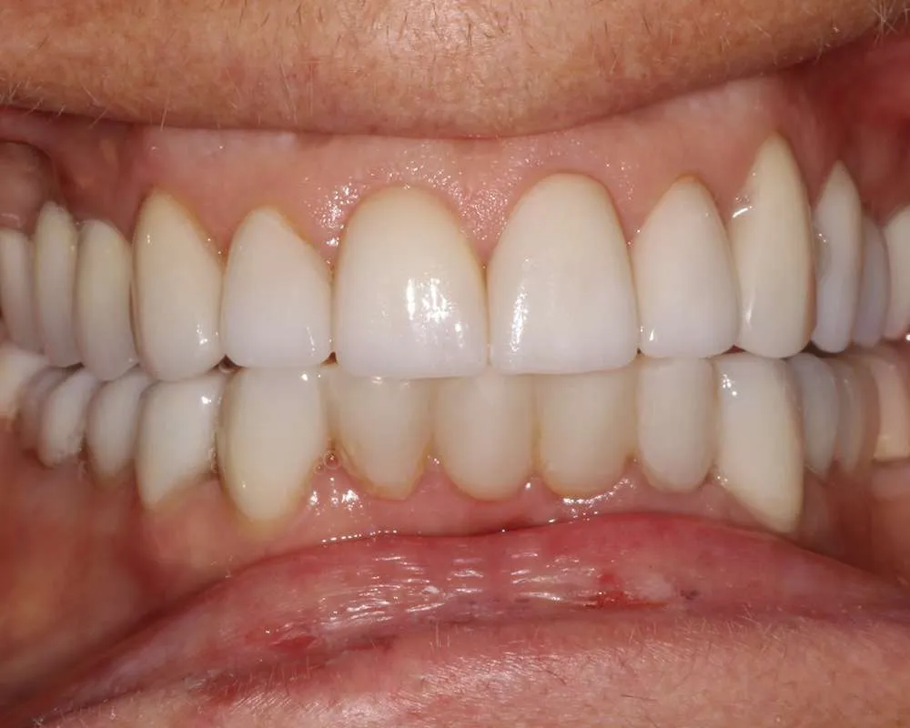 Photo of Before Retracted denture