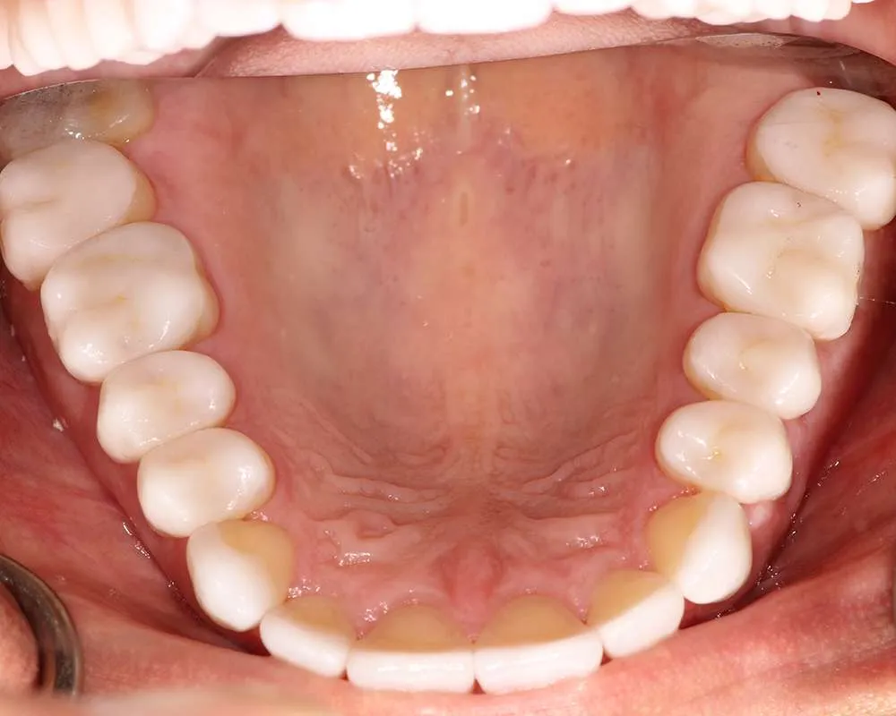 Photo of after upper veneers