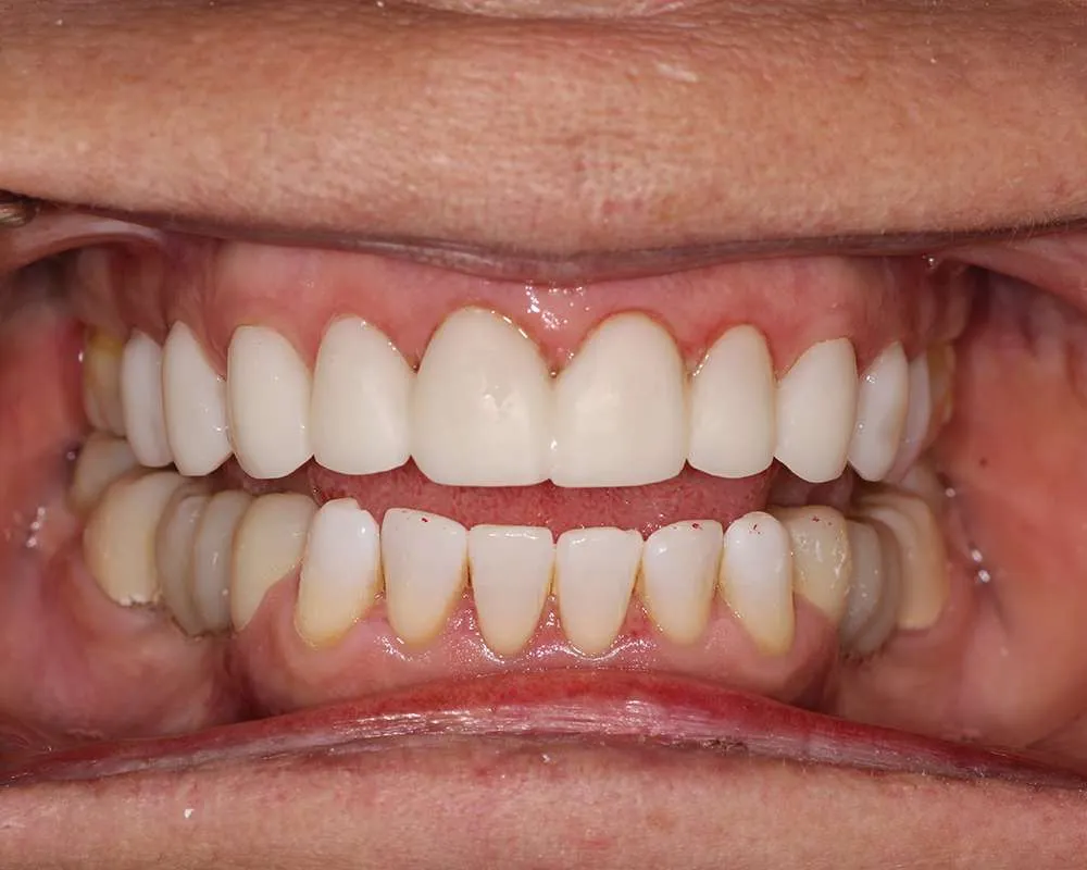 Photo of Temps Retracted denture