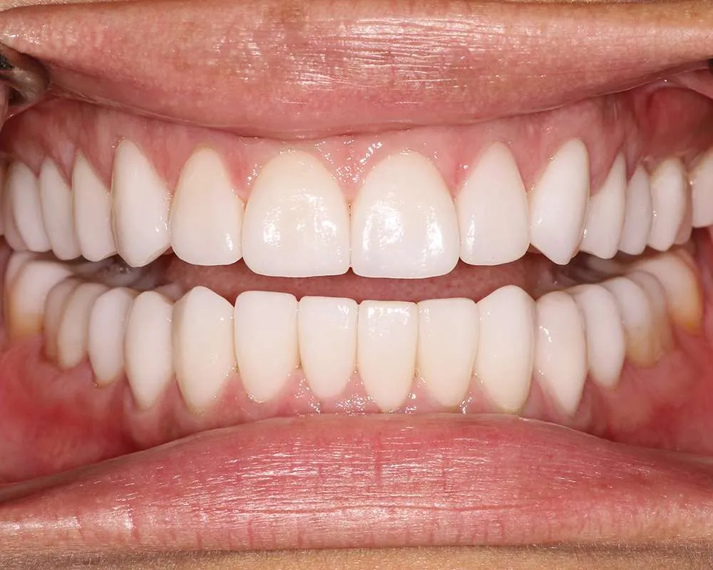Photo of after veneers retracted
