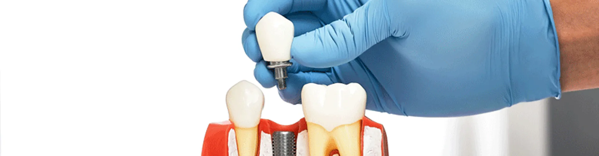 Gloved hand holding implant crown above jaw model with teeth and implant screw.