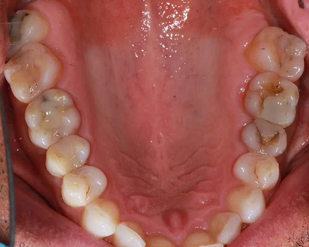 Photo of Before Uppers denture