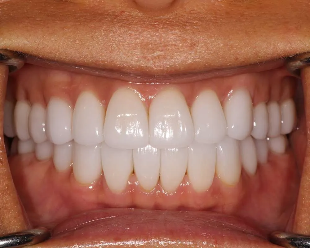 After retracted teeths denture photo