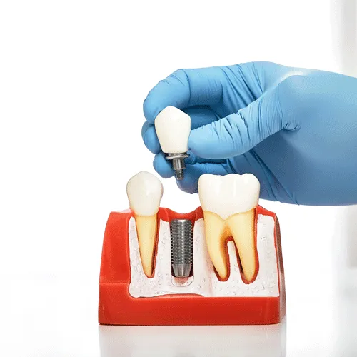 Gloved hand holding implant crown above jaw model with teeth and implant screw.