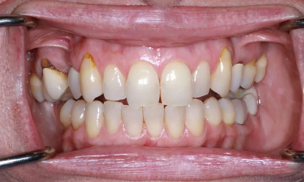 Photo of before retracted denture
