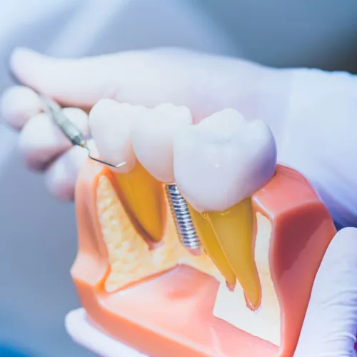 A dentist with a teeth model showing an implant.