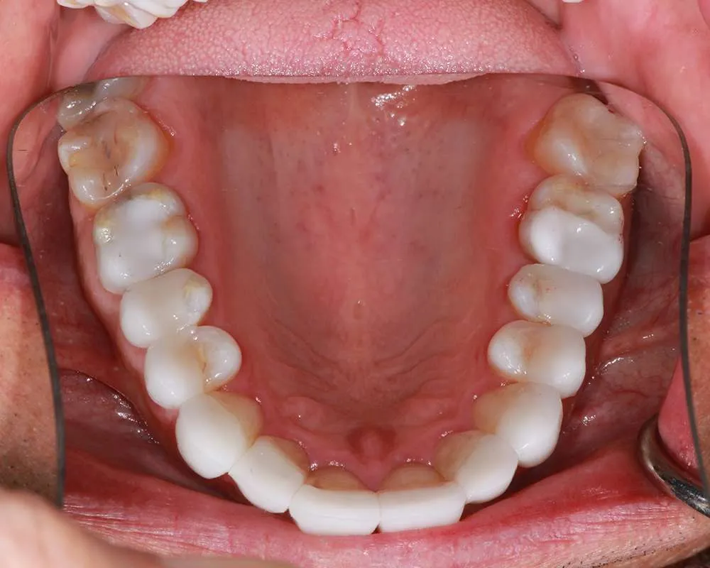 Photo of after upper denture