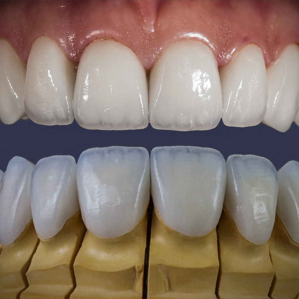 Detailed view of ultra-thin veneers applied to a dental model, showing the perfect alignment and realistic appearance of the veneers on upper teeth.