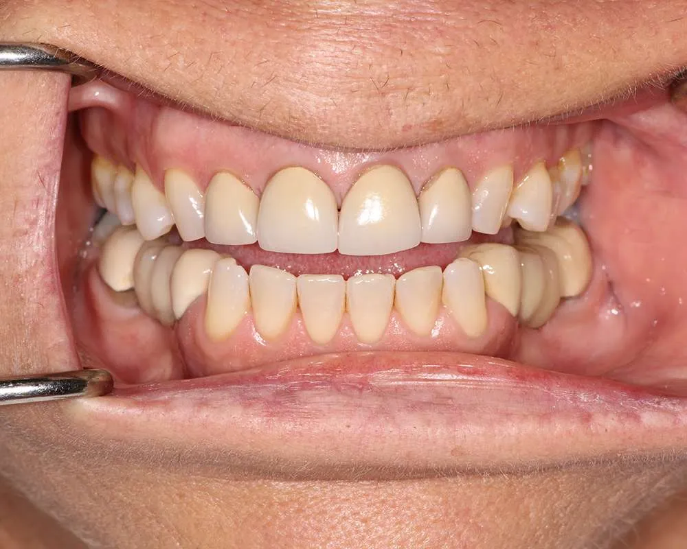 Photo of Before Uppers denture