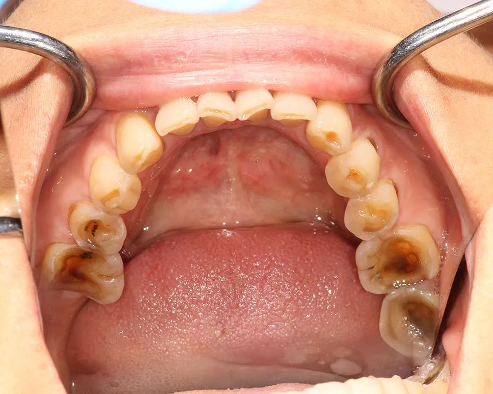 Before uppers denture photo