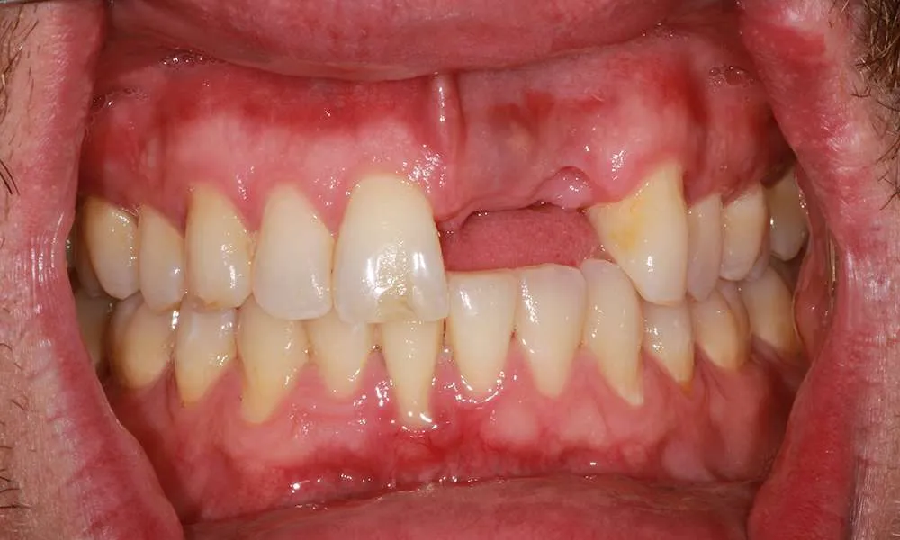 Photo of Before Retracted denture